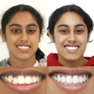 before and after 4