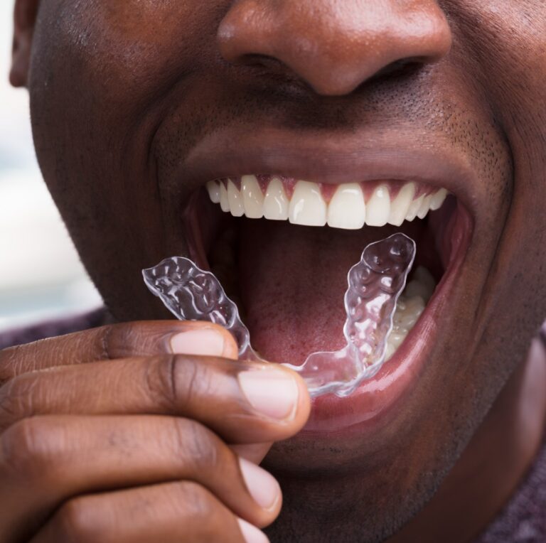 man with invisalign