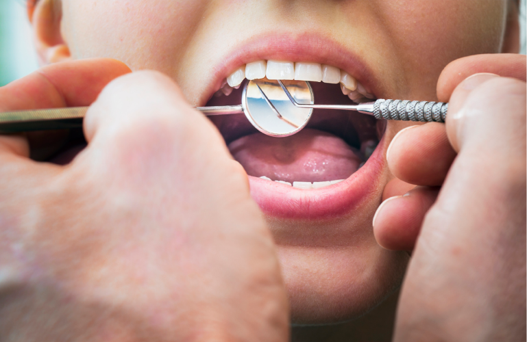 Bonded Retainer
